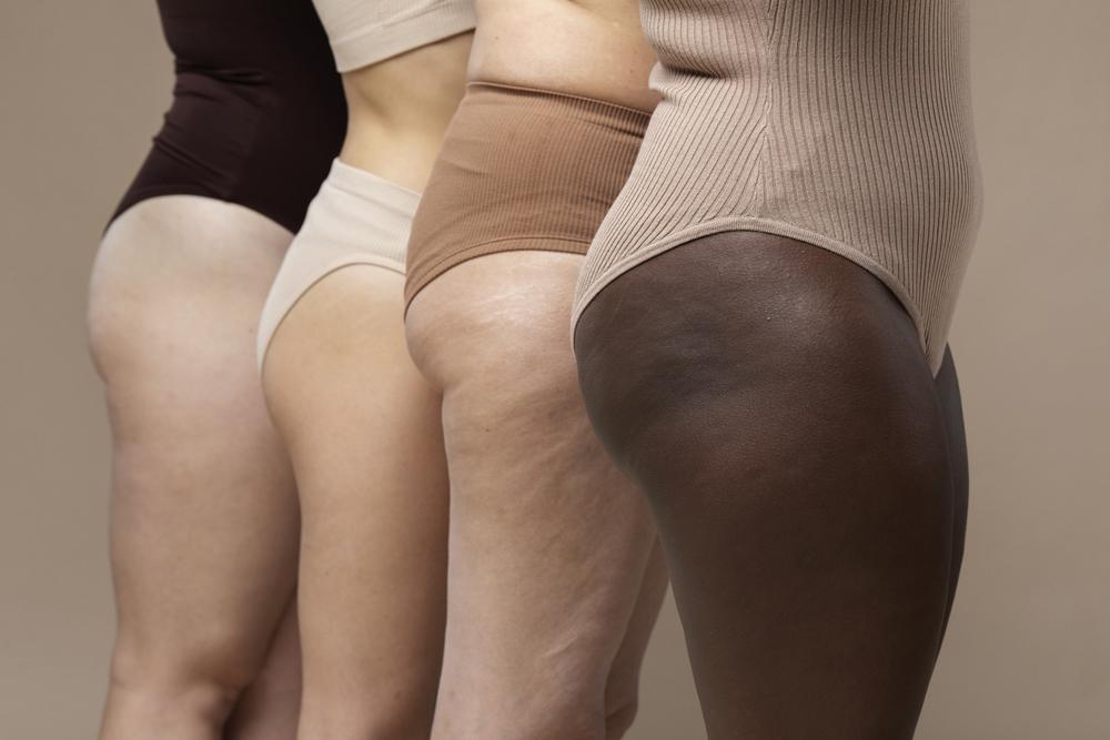 Lipedema: come l'abbigliamento a compressione graduata può alleviare i sintomi