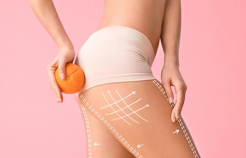 Rimedi cellulite: combattila con l'intimo modellante