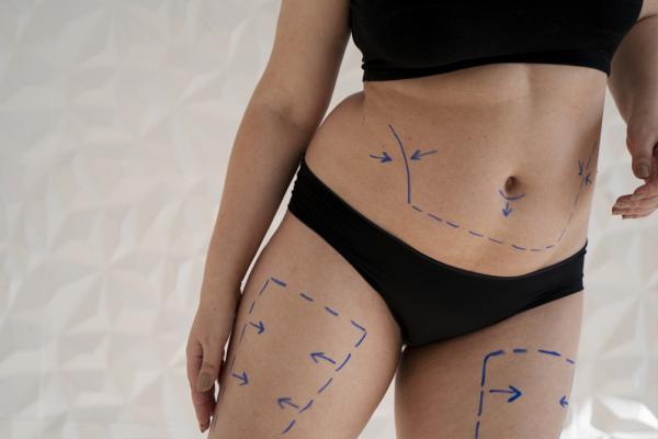 Guaina post liposuzione: perché è fondamentale e come scegliere la migliore